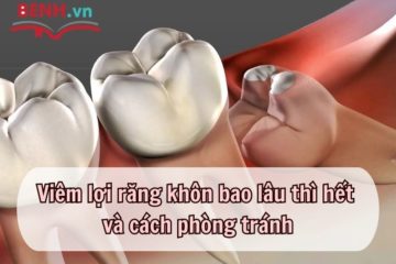 Viêm lợi răng khôn bao lâu thì hết và cách phòng tránh