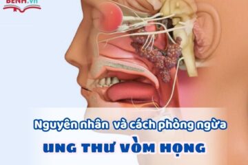 nguyen-nhan-ung-thu-vom-hong-huong-dan-cach-phong-ngua-1