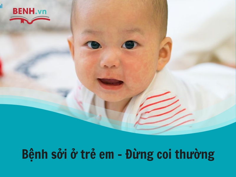 Bệnh sởi ở trẻ em - đừng coi thường - Benh.vn