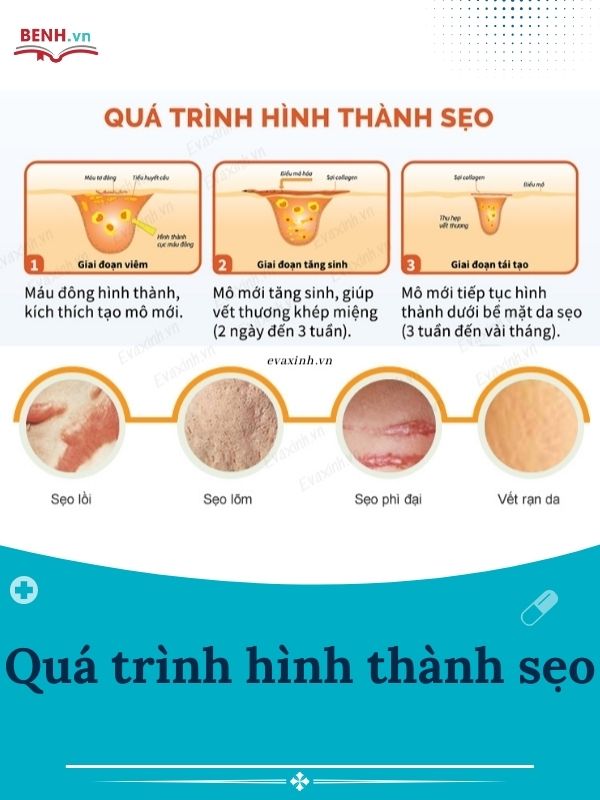 Thuoc-tri-seo-cho-tre-em-cua-nhat-top-5-san-pham-tot-nhat-01